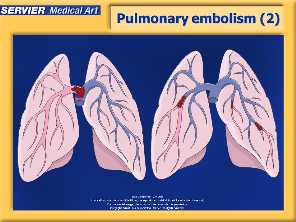 Pulmonary embolism (2)